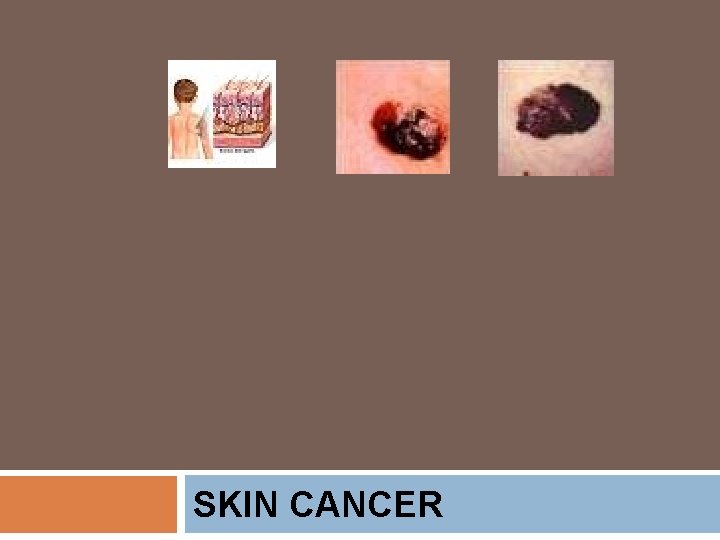 SKIN CANCER 