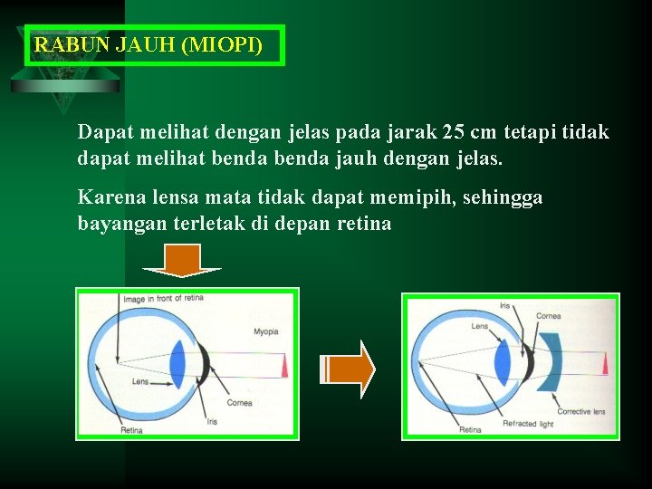 RABUN JAUH (MIOPI) Dapat melihat dengan jelas pada jarak 25 cm tetapi tidak dapat