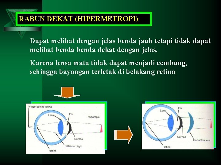 RABUN DEKAT (HIPERMETROPI) Dapat melihat dengan jelas benda jauh tetapi tidak dapat melihat benda