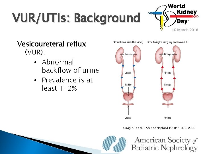 VUR/UTIs: Background Vesicoureteral reflux (VUR): • Abnormal backflow of urine • Prevalence is at