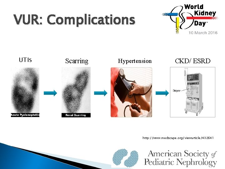 VUR: Complications UTIs Scarring Hypertension CKD/ ESRD http: //www. medscape. org/viewarticle/432641 