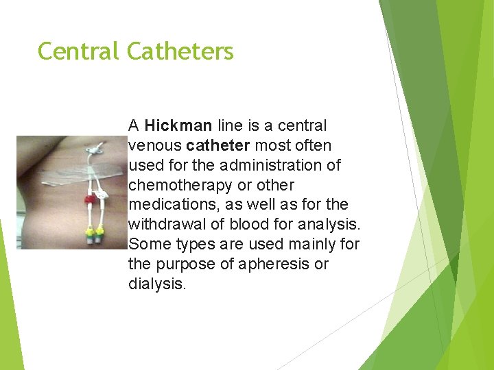 Central Catheters A Hickman line is a central venous catheter most often used for