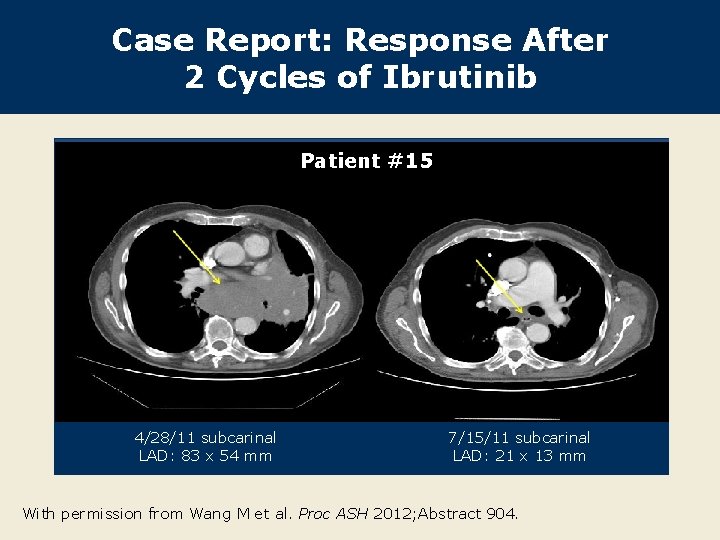 Case Report: Response After 2 Cycles of Ibrutinib Patient #15 4/28/11 subcarinal LAD: 83