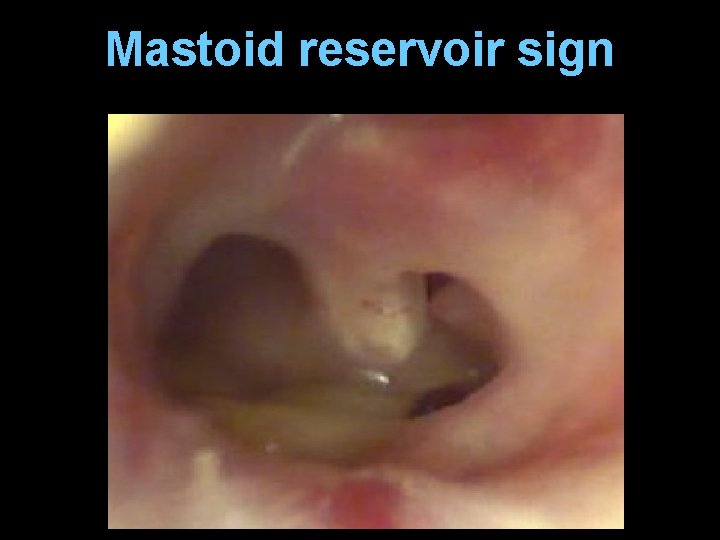 Mastoid reservoir sign 