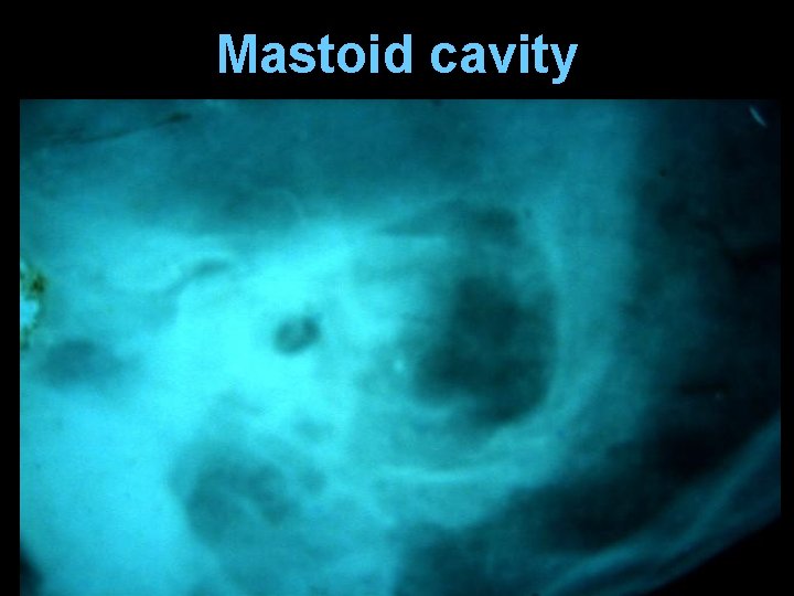 Mastoid cavity 