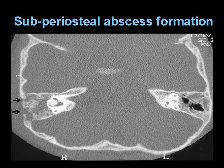 Sub-periosteal abscess formation 