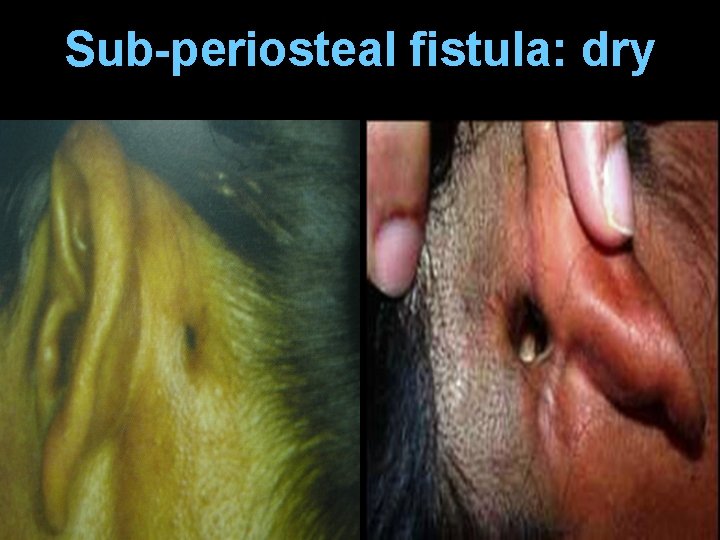Sub-periosteal fistula: dry 