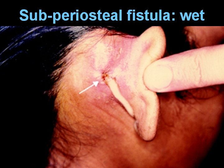 Sub-periosteal fistula: wet 