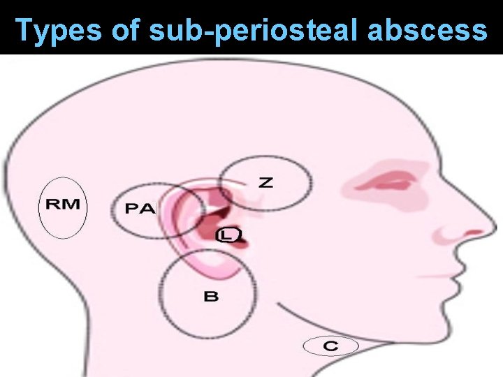 Types of sub-periosteal abscess 