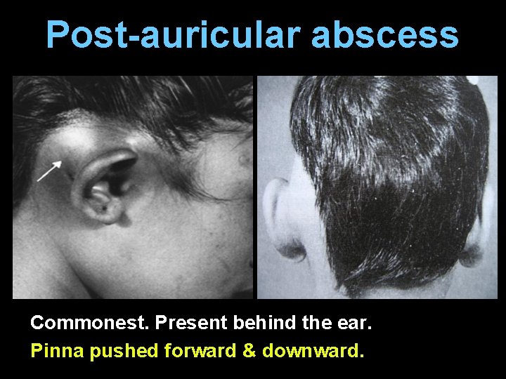 Post-auricular abscess Commonest. Present behind the ear. Pinna pushed forward & downward. 