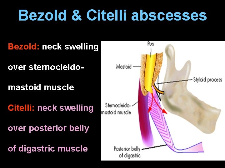 Bezold & Citelli abscesses Bezold: neck swelling over sternocleidomastoid muscle Citelli: neck swelling over
