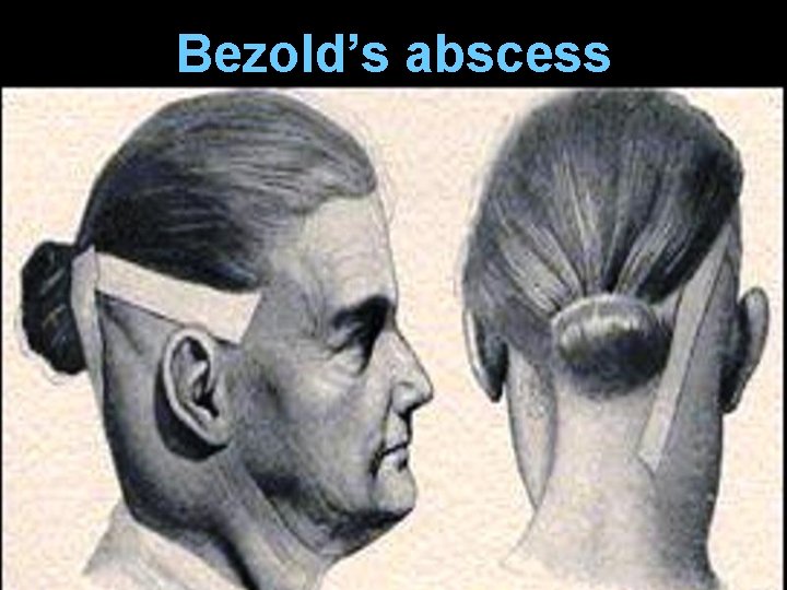 Bezold’s abscess 