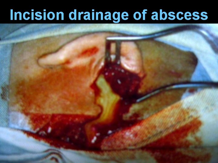 Incision drainage of abscess 