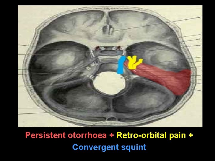 Persistent otorrhoea + Retro-orbital pain + Convergent squint 