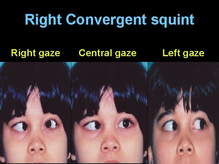 Right Convergent squint Right gaze Central gaze Left gaze 