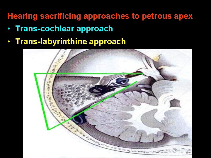 Hearing sacrificing approaches to petrous apex • Trans-cochlear approach • Trans-labyrinthine approach 