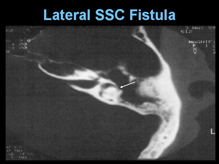 Lateral SSC Fistula 