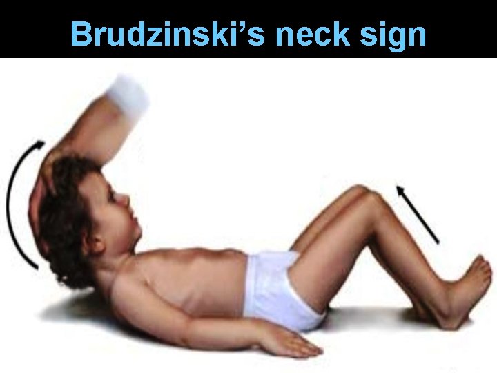 Brudzinski’s neck sign 