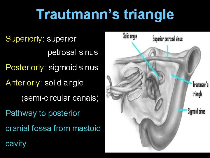Trautmann’s triangle Superiorly: superior petrosal sinus Posteriorly: sigmoid sinus Anteriorly: solid angle (semi-circular canals)