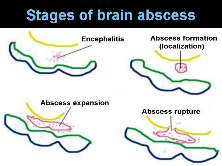 Stages of brain abscess 