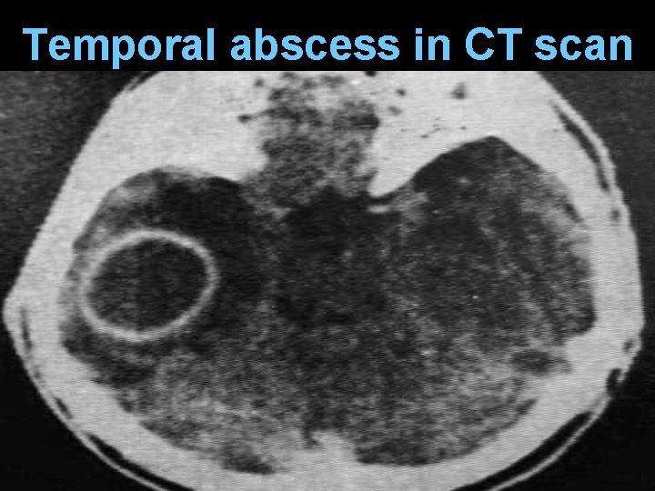 Temporal abscess in CT scan 