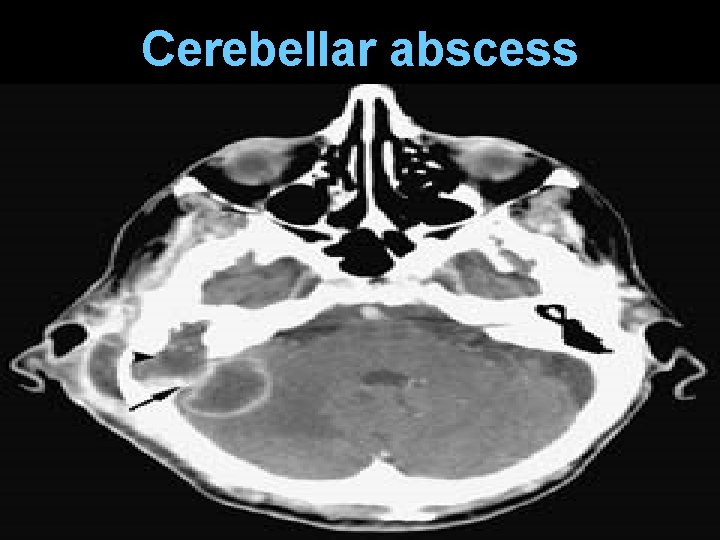 Cerebellar abscess 