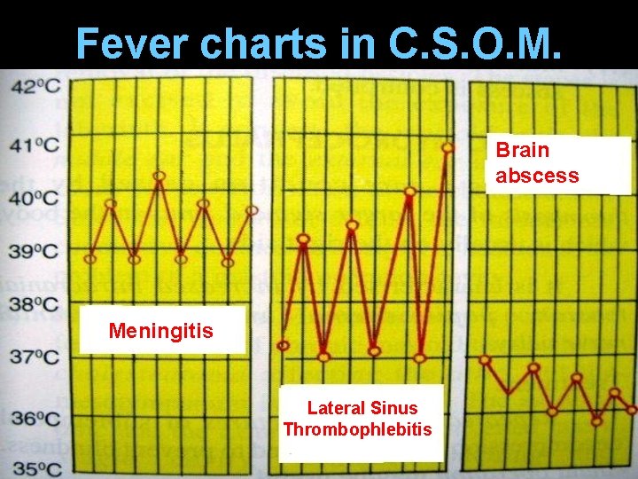Fever charts in C. S. O. M. Brain abscess Meningitis Lateral Sinus Thrombophlebitis 