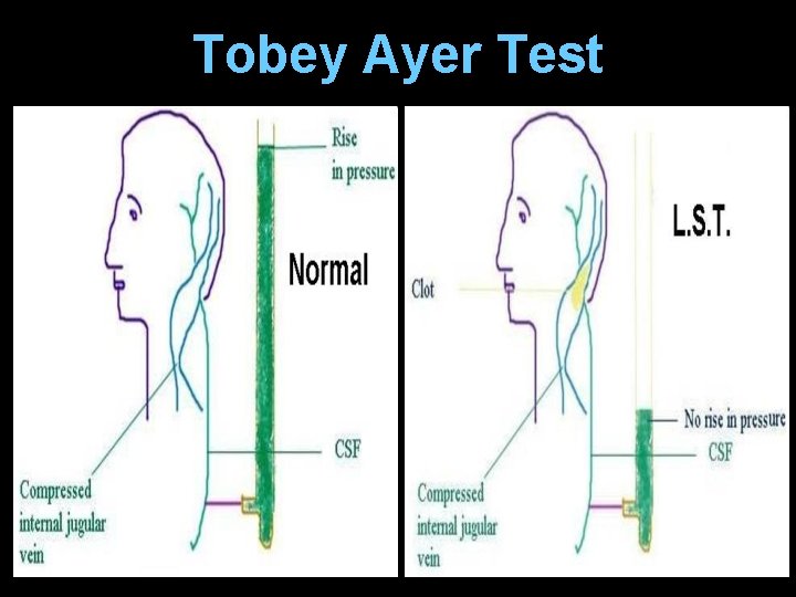 Tobey Ayer Test 