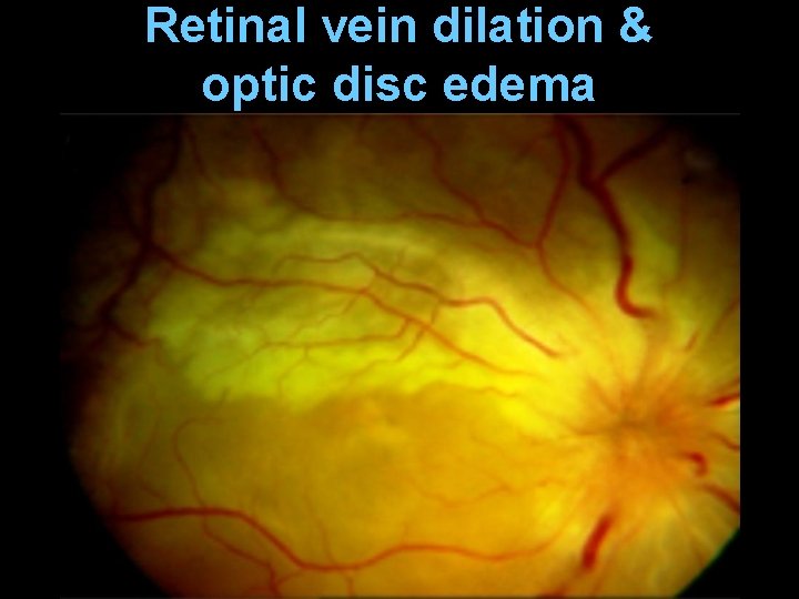 Retinal vein dilation & optic disc edema 