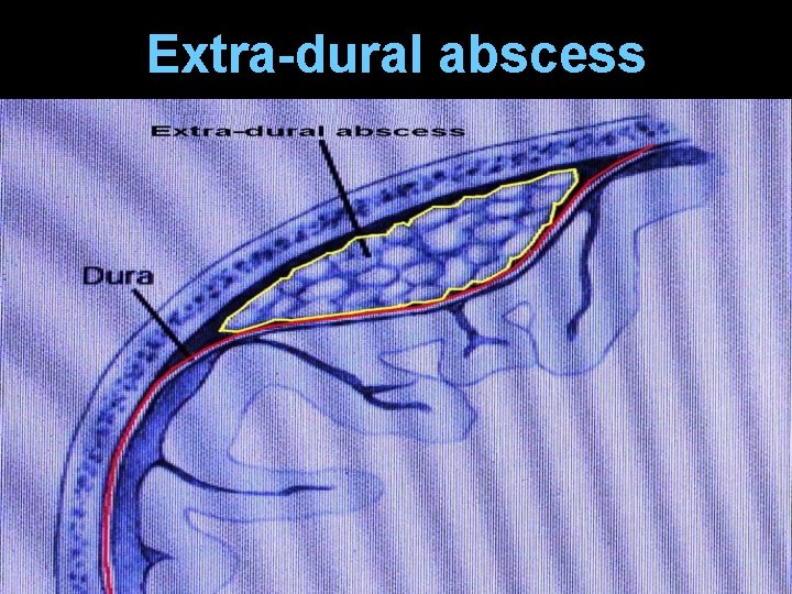 Extra-dural abscess 