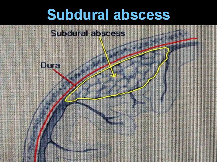 Subdural abscess 