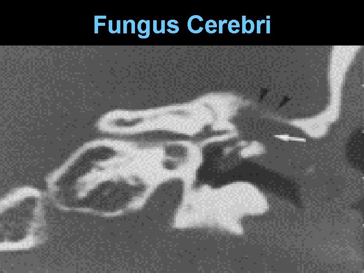 Fungus Cerebri 