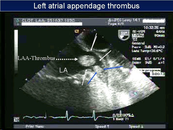 Left atrial appendage thrombus LAA-Thrombus LA 