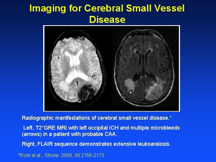 Imaging for Cerebral Small Vessel Disease Radiographic manifestations of cerebral small vessel disease. *