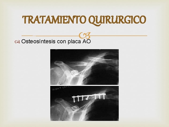 TRATAMIENTO QUIRURGICO Osteosíntesis con placa AO 