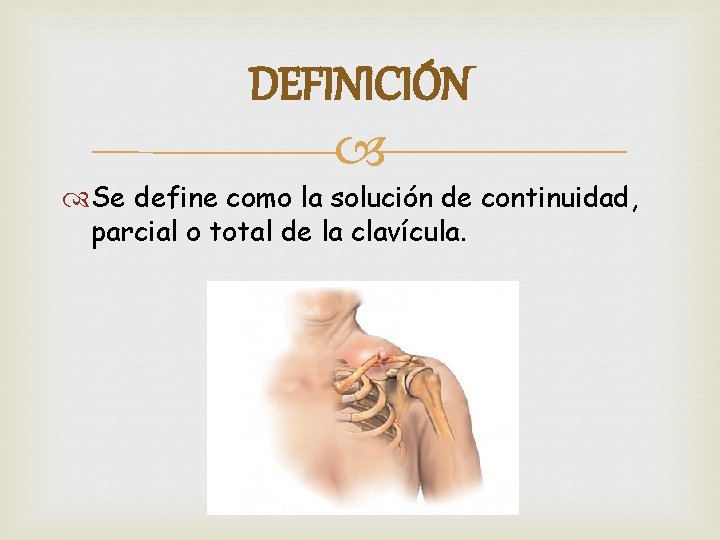 DEFINICIÓN Se define como la solución de continuidad, parcial o total de la clavícula.