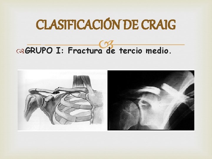 CLASIFICACIÓN DE CRAIG GRUPO I: Fractura de tercio medio. 