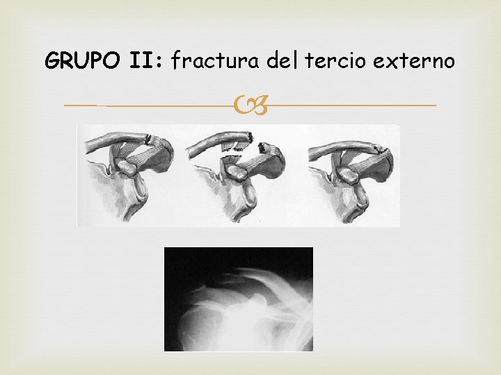 GRUPO II: fractura del tercio externo 