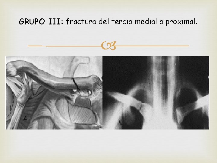 GRUPO III: fractura del tercio medial o proximal. 