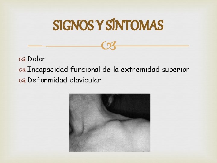 SIGNOS Y SÍNTOMAS Dolor Incapacidad funcional de la extremidad superior Deformidad clavicular 