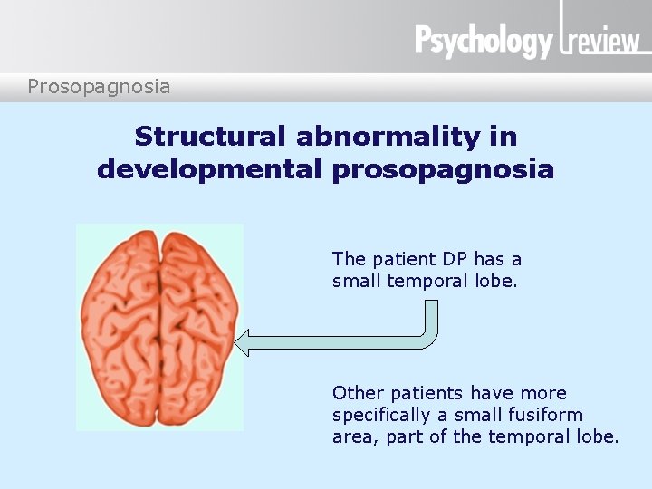 Prosopagnosia Structural abnormality in developmental prosopagnosia The patient DP has a small temporal lobe.