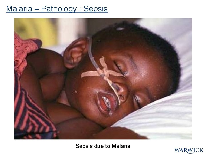 Malaria – Pathology : Sepsis due to Malaria Malaria – Pathology : Sepsis due to Malaria