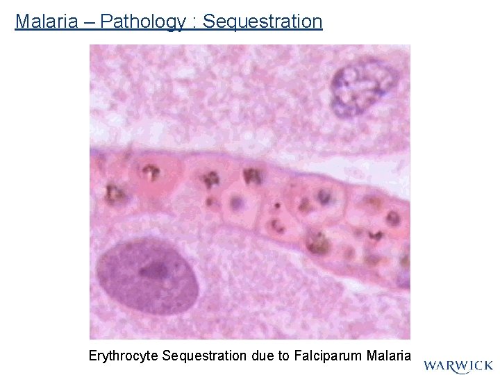 Malaria – Pathology : Sequestration Erythrocyte Sequestration due to Falciparum Malaria Malaria – Pathology : Sequestration Erythrocyte Sequestration due to Falciparum Malaria