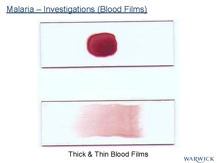 Malaria – Investigations (Blood Films) Thick & Thin Blood Films Malaria – Investigations (Blood Films) Thick & Thin Blood Films