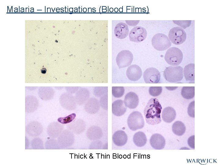 Malaria – Investigations (Blood Films) Thick & Thin Blood Films Malaria – Investigations (Blood Films) Thick & Thin Blood Films