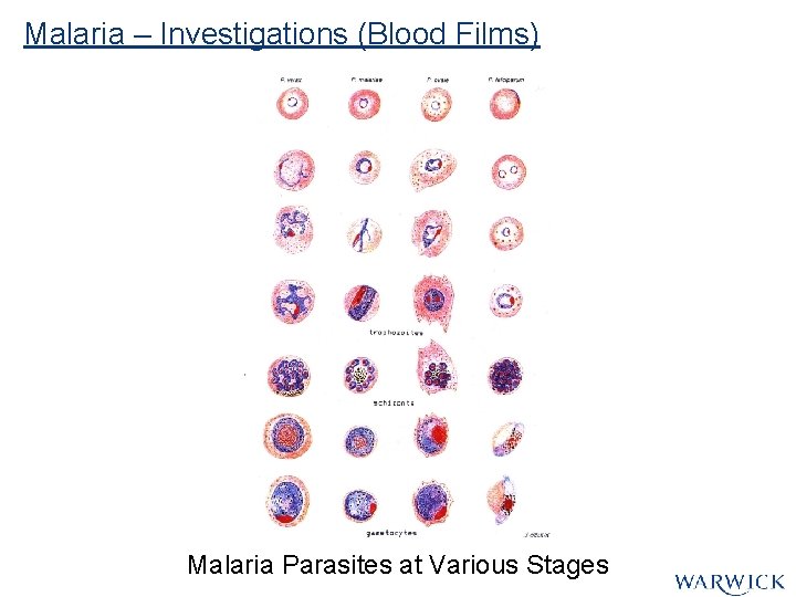 Malaria – Investigations (Blood Films) Malaria Parasites at Various Stages Malaria – Investigations (Blood Films) Malaria Parasites at Various Stages