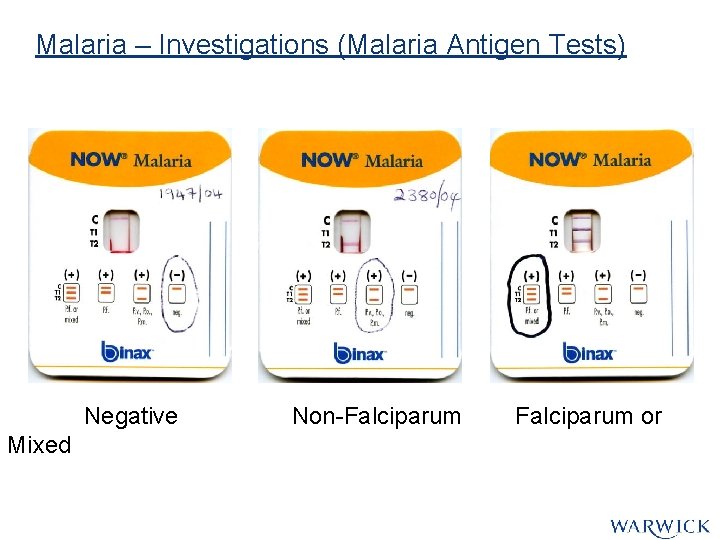 Malaria – Investigations (Malaria Antigen Tests) Negative Mixed Non-Falciparum or Malaria – Investigations (Malaria Antigen Tests) Negative Mixed Non-Falciparum or