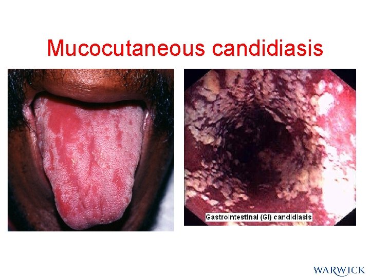 Mucocutaneous candidiasis Mucocutaneous candidiasis