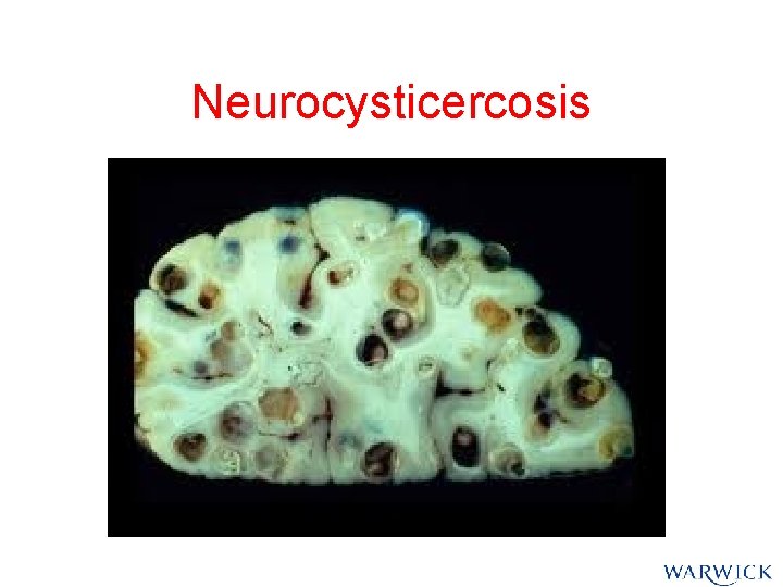 Neurocysticercosis Neurocysticercosis
