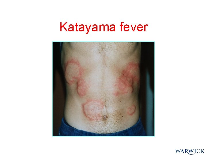 Katayama fever Katayama fever